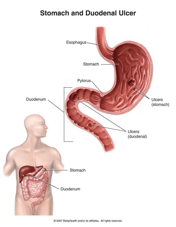 imagine cu ulcerul gastric